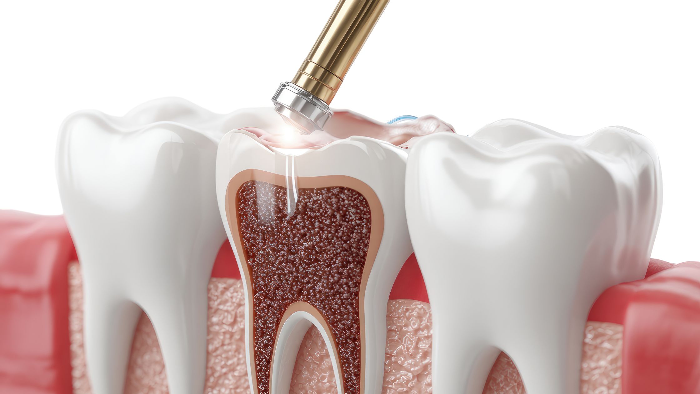 Root Canal Treatment in Lucknow
